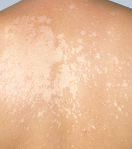 Tinea Versicolor